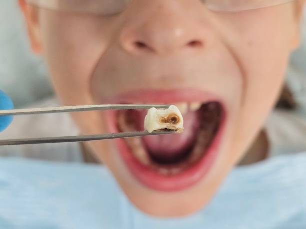 Best Dentist for Tooth Abscess  in Horton, KS